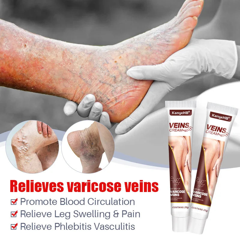 20g Varicose Vein Relief Cream Improves Blood Circulation Relaxing Leg Cream Relieve Spider Blood Vessels Anti Varicose Cream