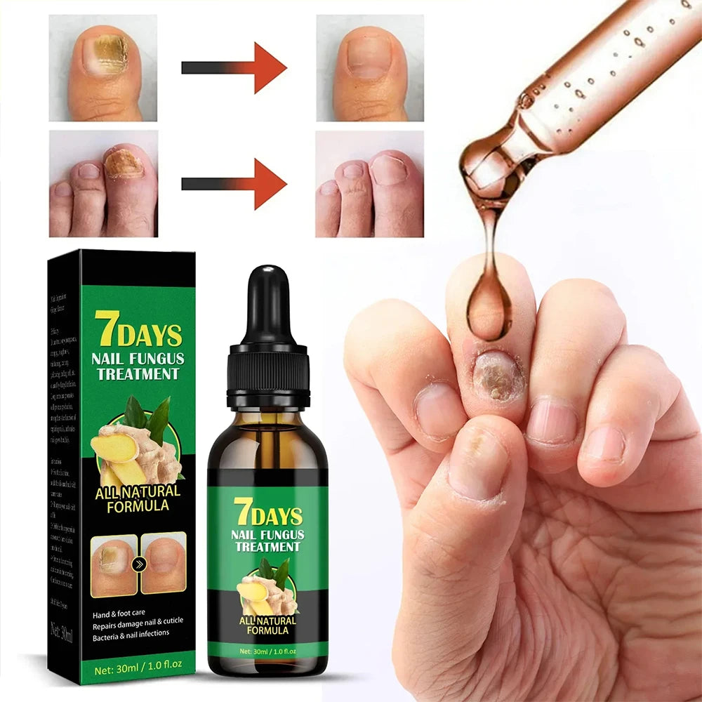 Nail Fungal Treatment Device 7 Days Repair Oil Foot Toe Essence Anti Infection Paronychia Ginger Onychomycosis Gel Care Products