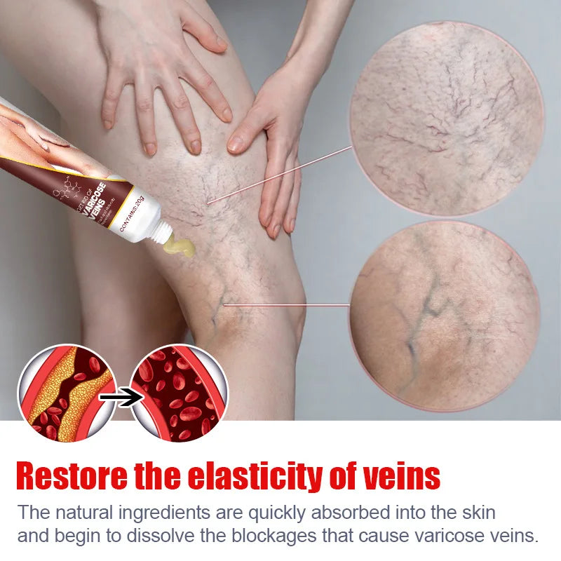 20g Varicose Vein Relief Cream Improves Blood Circulation Relaxing Leg Cream Relieve Spider Blood Vessels Anti Varicose Cream