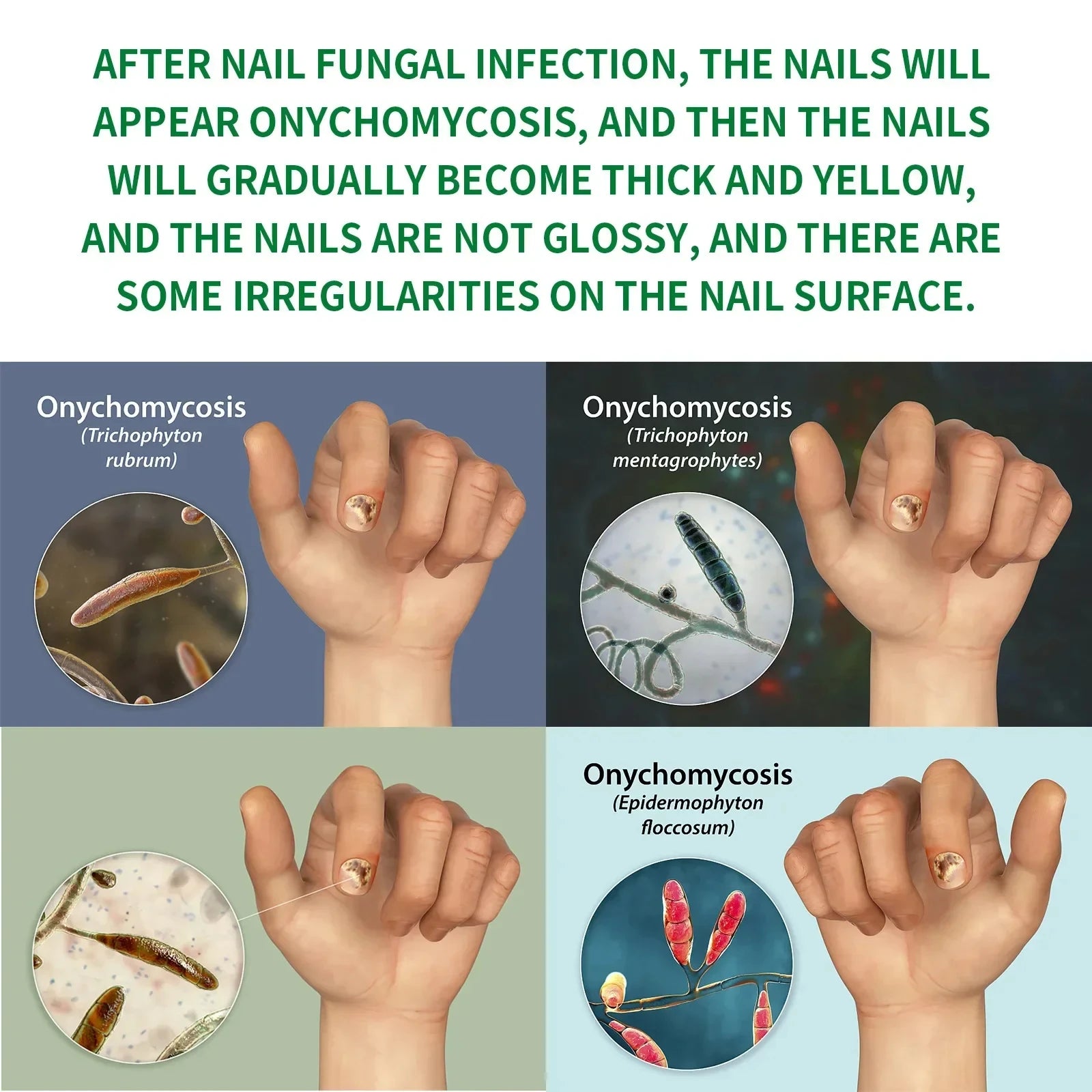 Nail Fungal Treatment Device 7 Days Repair Oil Foot Toe Essence Anti Infection Paronychia Ginger Onychomycosis Gel Care Products