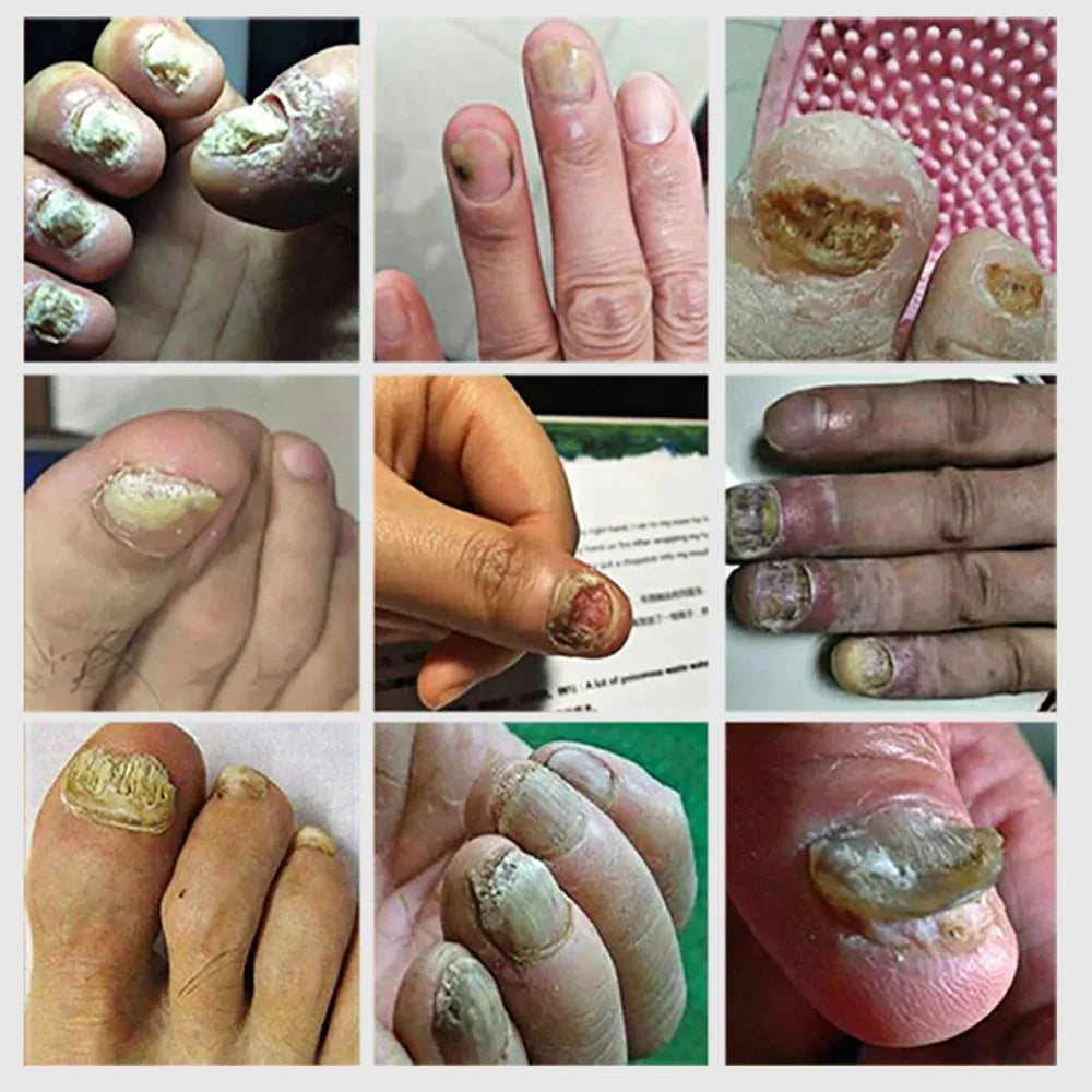 Nail Fungal Treatment Device 7 Days Repair Oil Foot Toe Essence Anti Infection Paronychia Ginger Onychomycosis Gel Care Products